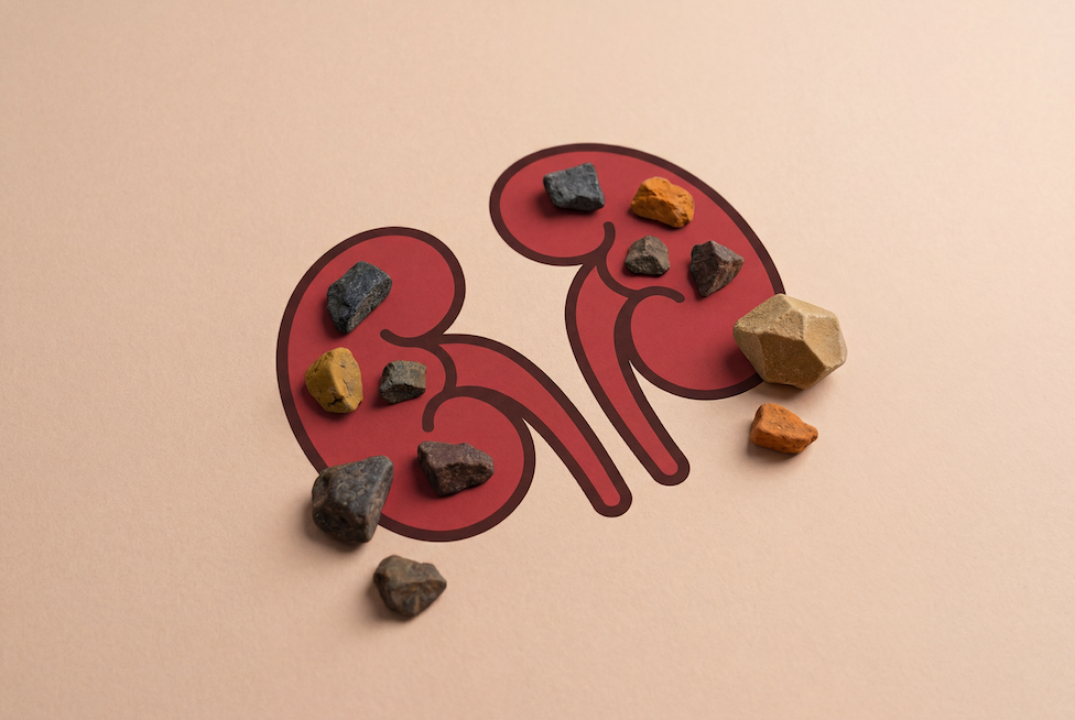 腎結石高風險群